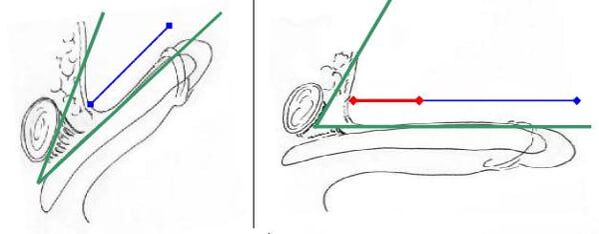 Increasing the length of the penis due to the intersection of the ligament
