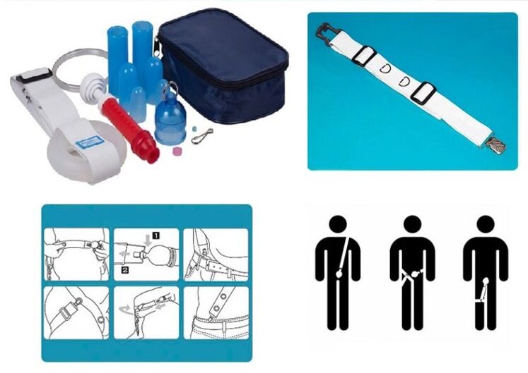 Lengthening and widening of the penis can be achieved with a stretcher
